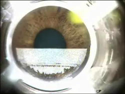 Figure Five - LASIK Flap Within the Corneal Stroma Figure Five - LASIK Flap Within the Corneal Stroma