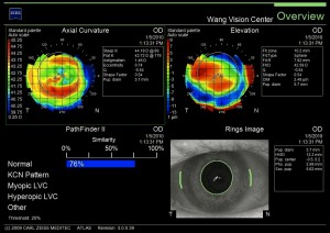 Figure Six - Topographic Corneal Map Figure Six - Topographic Corneal Map