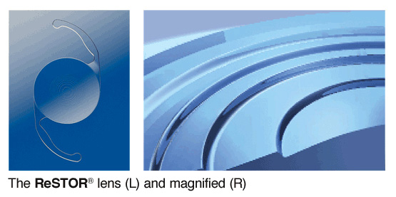 Presbyopia-Correcting IOLs Presbyopia-Correcting ReSTOR Lens