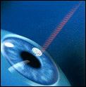 LASIK