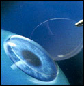 LASIK