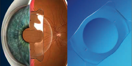 Visian Implantable Collamer Lens (ICL) Visian Implantable Collamer Lens (ICL)