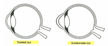 normal eye compared to keratoconus eye