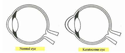 Keratoconus eye diagram